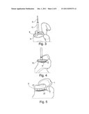 Allogenic Articular Cavity Prosthesis and Method for Implanting the Same diagram and image