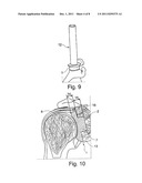 Allogenic Articular Cavity Prosthesis and Method for Implanting the Same diagram and image