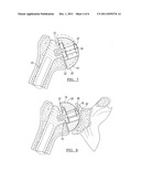 Method And Apparatus For Trialing A Modular Humeral Head diagram and image