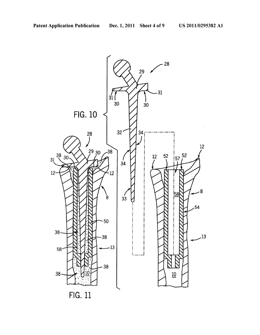 PROSTHETIC IMPLANT SUPPORT STRUCTURE - diagram, schematic, and image 05