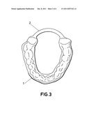 INTRAORAL FERRULE diagram and image