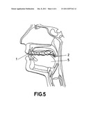 INTRAORAL FERRULE diagram and image