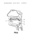 INTRAORAL FERRULE diagram and image