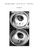 PHARMACOLOGICAL VITREOLYSIS diagram and image