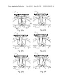 SURGICAL RETRACTOR diagram and image