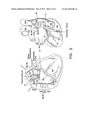 Apparatus and Methods for Arrhythmia Treatment Based on Spectral Mapping     During Sinus Rhythm diagram and image