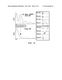 Apparatus and Methods for Arrhythmia Treatment Based on Spectral Mapping     During Sinus Rhythm diagram and image