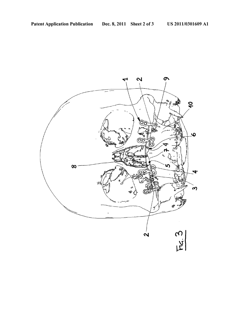 CUSTOMISED ASSEMBLY INCLUDING AT LEAST TWO OSTEOSYNTHESIS PLATES WHICH ARE     IN TURN CUSTOMISED - diagram, schematic, and image 03