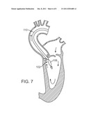 Prosthetic Valve Delivery System diagram and image