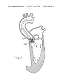 Prosthetic Valve Delivery System diagram and image