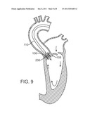 Prosthetic Valve Delivery System diagram and image