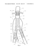ILIAC EXTENSION WITH FLARED CUFF diagram and image