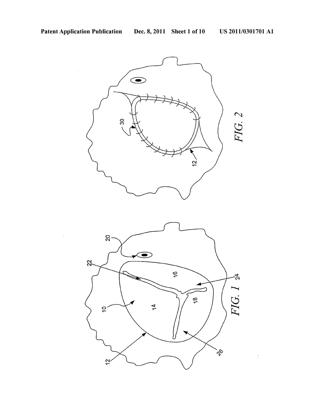 METHOD AND APPARATUS FOR MINIMALLY INVASIVE HEART VALVE PROCEDURES - diagram, schematic, and image 02