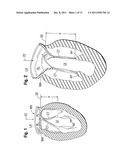 Annuloplasty Rings for Repair of Abnormal Mitral Valves diagram and image