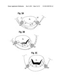 Annuloplasty Rings for Repair of Abnormal Mitral Valves diagram and image