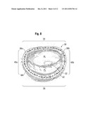 Annuloplasty Rings for Repair of Abnormal Mitral Valves diagram and image