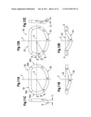 Annuloplasty Rings for Repair of Abnormal Mitral Valves diagram and image