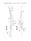 Annuloplasty Rings for Repair of Abnormal Mitral Valves diagram and image