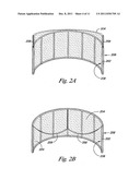 Cardiac Valve, System, and Method diagram and image