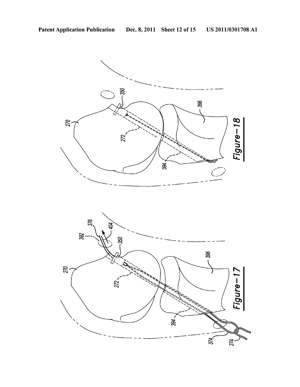 Method and Apparatus for Soft Tissue Fixation - diagram, schematic, and image 13