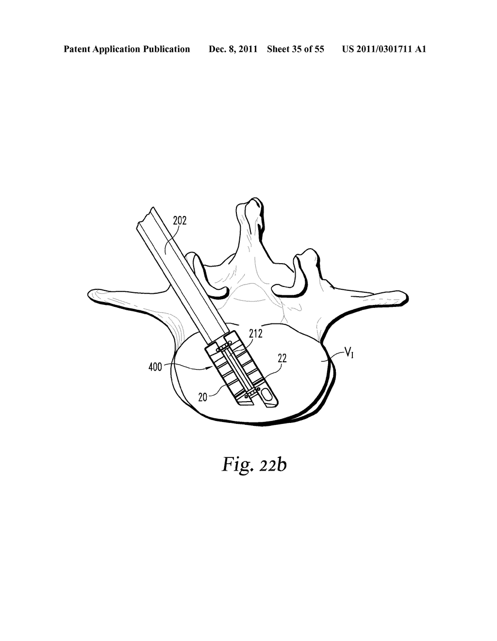 SYSTEM AND METHODS FOR A LATERALLY EXPANDING IMPLANT - diagram, schematic, and image 36