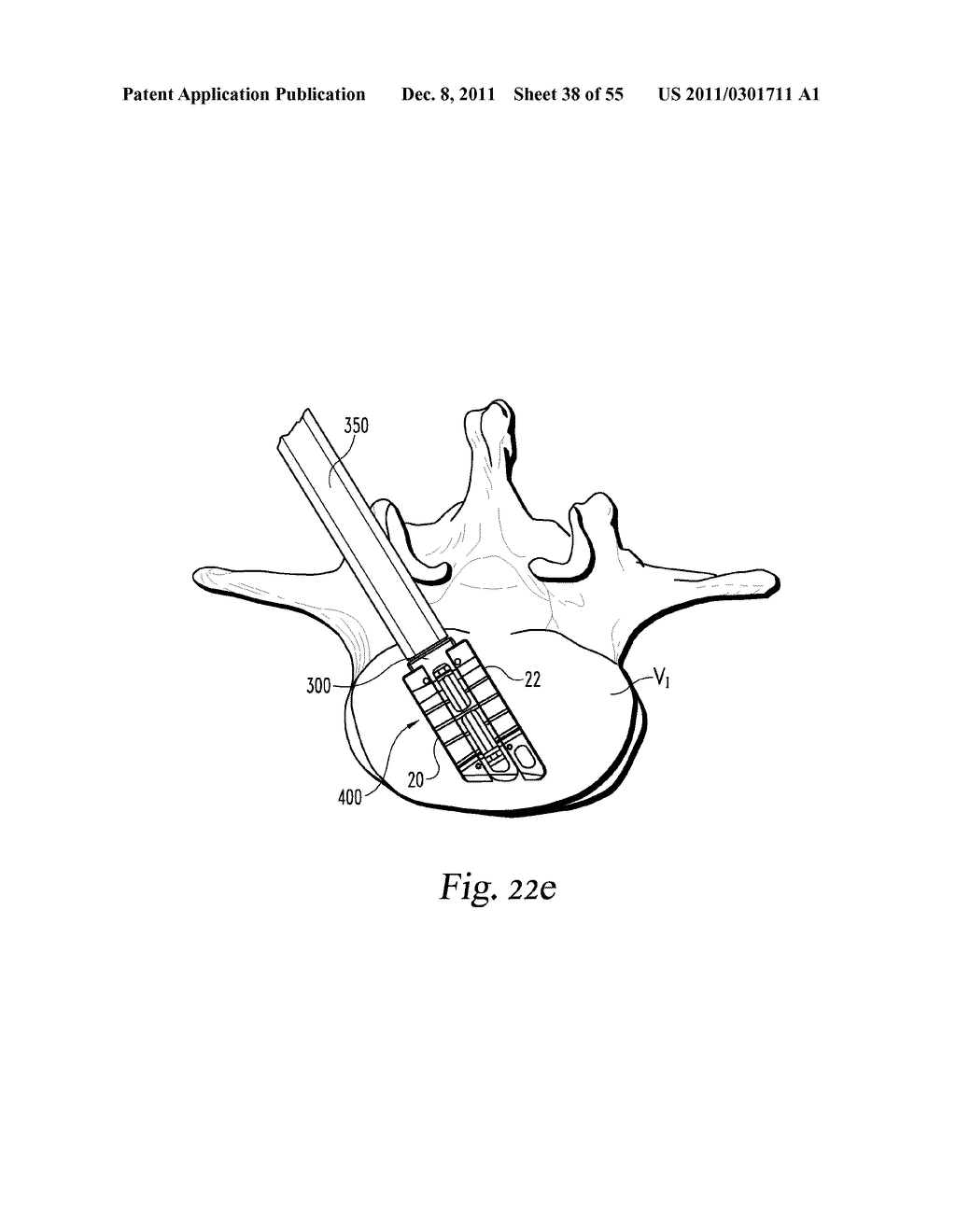 SYSTEM AND METHODS FOR A LATERALLY EXPANDING IMPLANT - diagram, schematic, and image 39