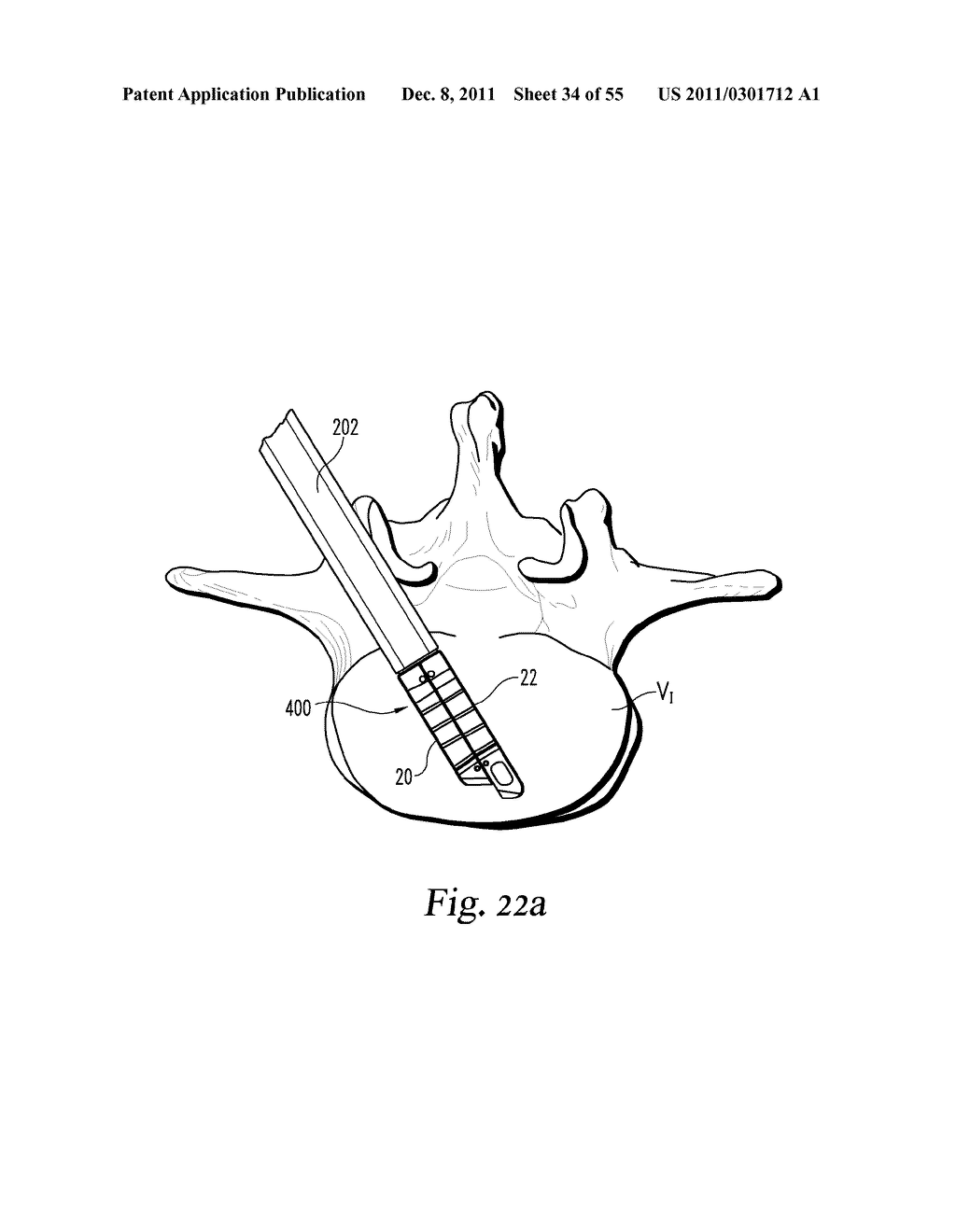 SYSTEM AND METHODS FOR A LATERALLY EXPANDING IMPLANT - diagram, schematic, and image 35