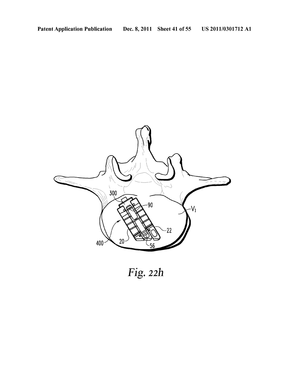 SYSTEM AND METHODS FOR A LATERALLY EXPANDING IMPLANT - diagram, schematic, and image 42