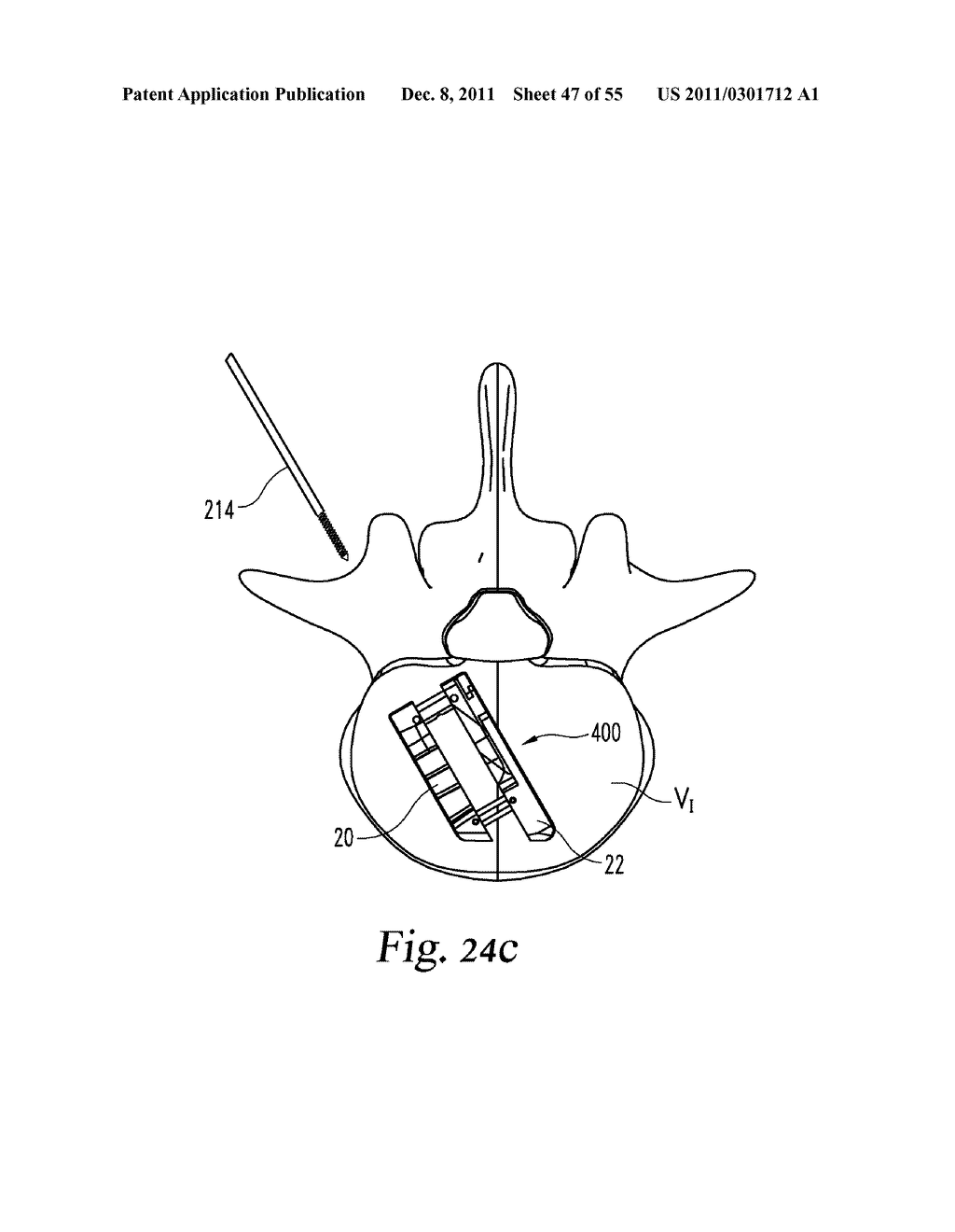 SYSTEM AND METHODS FOR A LATERALLY EXPANDING IMPLANT - diagram, schematic, and image 48