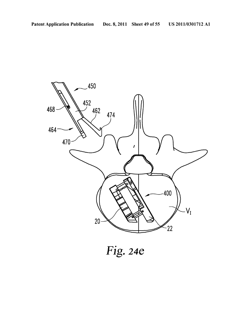 SYSTEM AND METHODS FOR A LATERALLY EXPANDING IMPLANT - diagram, schematic, and image 50