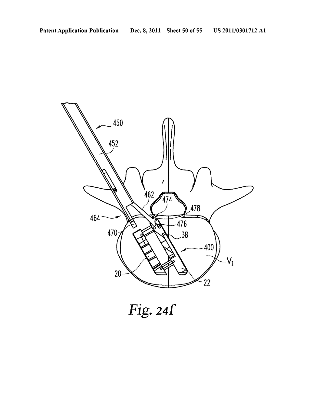 SYSTEM AND METHODS FOR A LATERALLY EXPANDING IMPLANT - diagram, schematic, and image 51