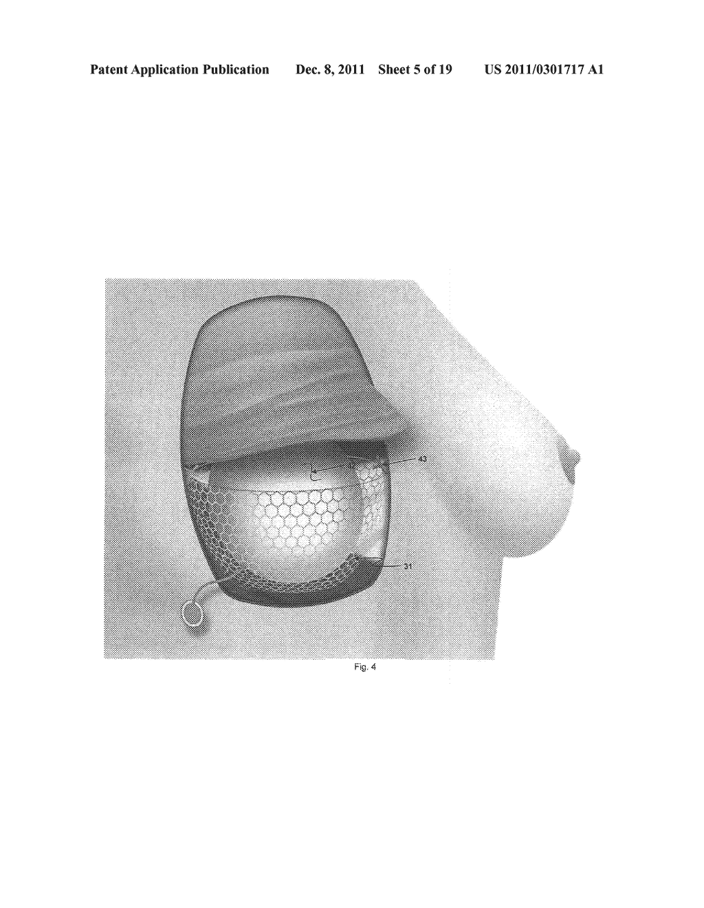 Supporting and Forming Transitional Material for Use in Supporting     Prosthesis Devices, Implants and to Provide Structure in a Human Body - diagram, schematic, and image 06