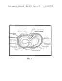 DEFORMABLE ARTICULATING TEMPLATE (formerly: CUSTOMIZED ORTHOPAEDIC     IMPLANTS & RELATED METHODS) diagram and image