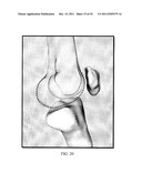 DEFORMABLE ARTICULATING TEMPLATE (formerly: CUSTOMIZED ORTHOPAEDIC     IMPLANTS & RELATED METHODS) diagram and image