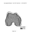 DEFORMABLE ARTICULATING TEMPLATE (formerly: CUSTOMIZED ORTHOPAEDIC     IMPLANTS & RELATED METHODS) diagram and image