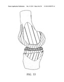 DEFORMABLE ARTICULATING TEMPLATE (formerly: CUSTOMIZED ORTHOPAEDIC     IMPLANTS & RELATED METHODS) diagram and image