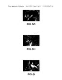 COMPOSITIONS AND METHODS FOR INHIBITING NF-KB MEDIATED TUMORIGENICITY AND     ADHESION-DEPENDENT SURVIVAL OF CANCER CELLS diagram and image