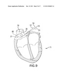 Methods, Devices And Systems For Cardioelectromagnetic Treatment diagram and image