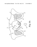 INCONTINENCE TREATMENT DEVICE diagram and image