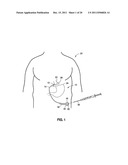 OVER MOLDED IMPLANTABLE DEVICE TO PROTECT TUBING FROM PUNCTURE diagram and image