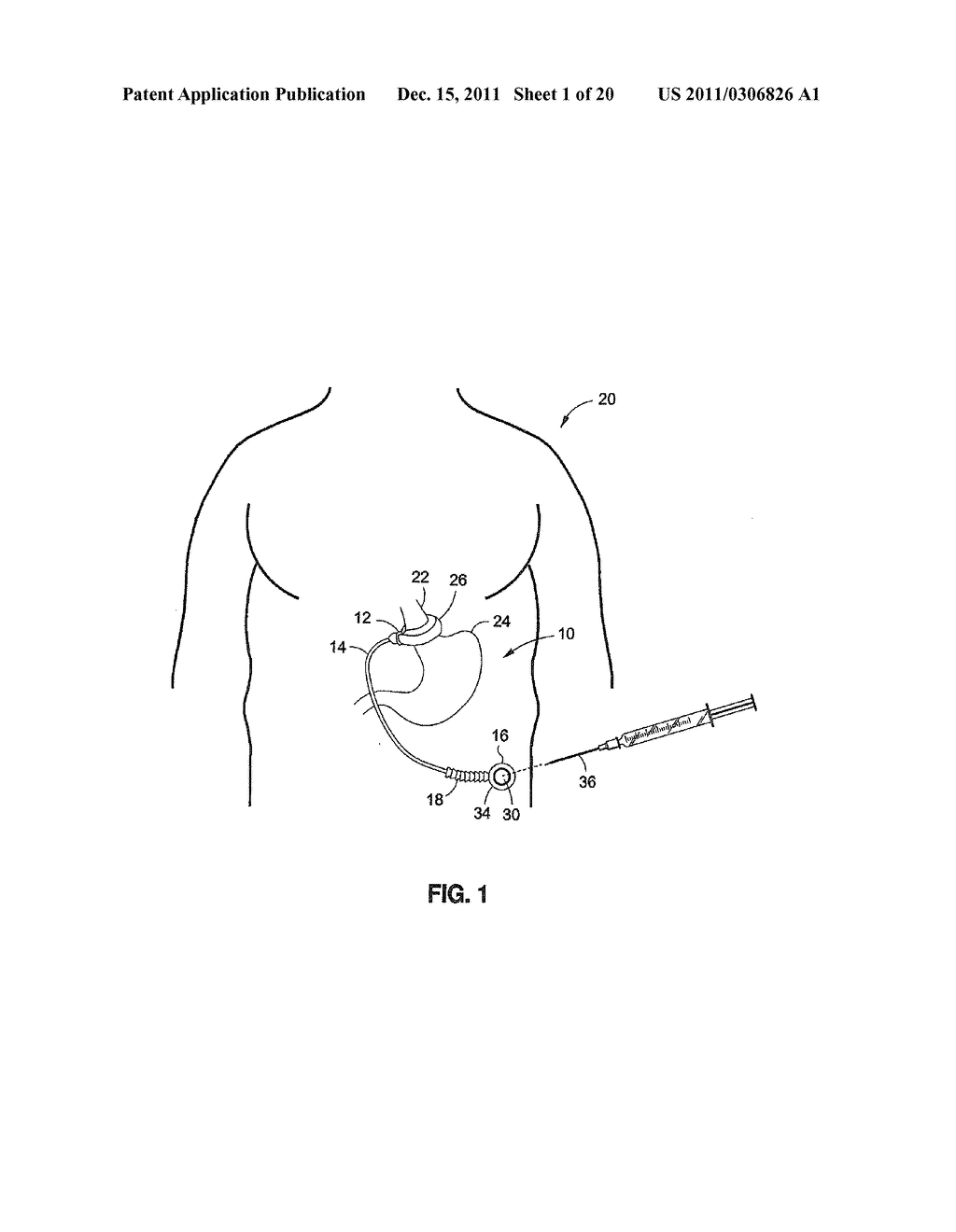 OVER MOLDED IMPLANTABLE DEVICE TO PROTECT TUBING FROM PUNCTURE - diagram, schematic, and image 02