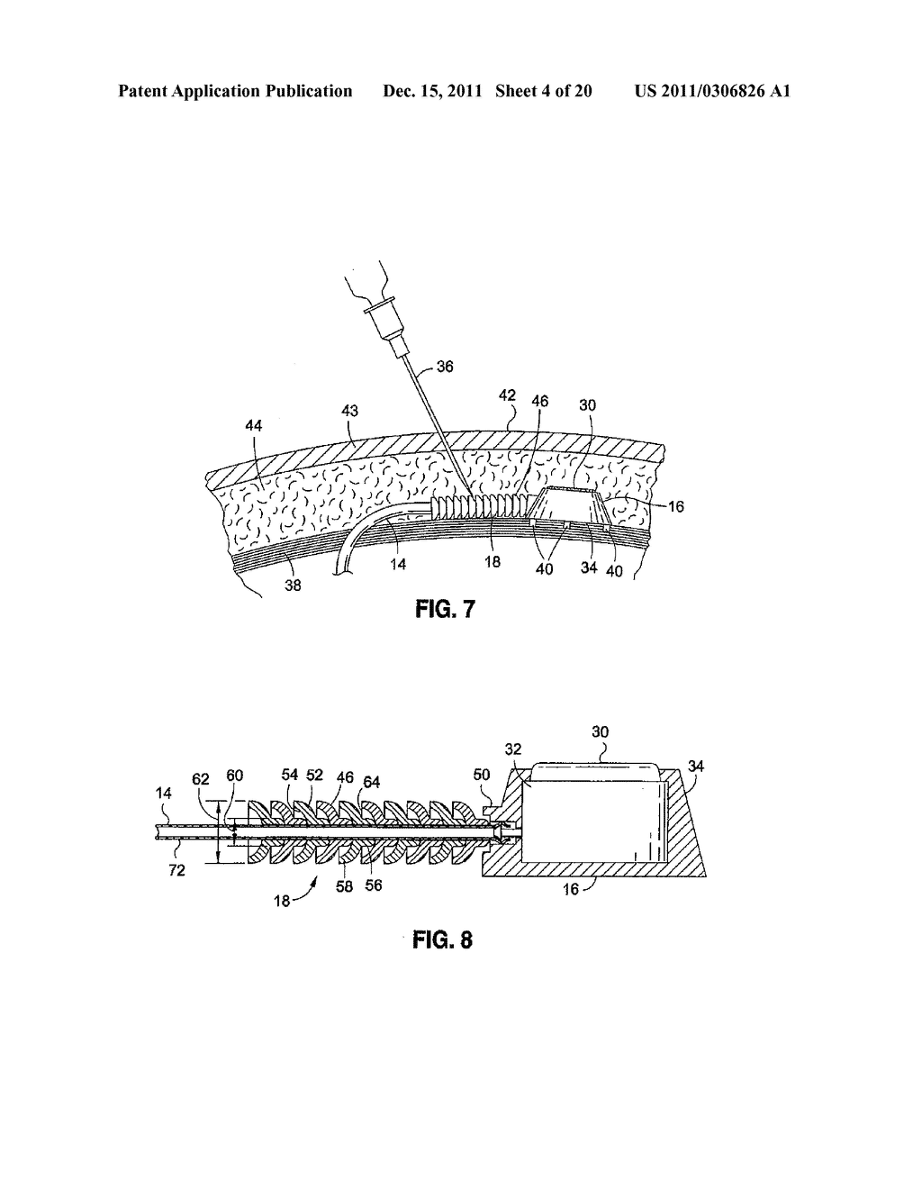 OVER MOLDED IMPLANTABLE DEVICE TO PROTECT TUBING FROM PUNCTURE - diagram, schematic, and image 05