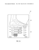 REMOVABLE CASSETTE FOR ARTICULAR INJECTION SYSTEM diagram and image