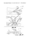 LASER-BASED METHOD AND SYSTEM FOR SELECTIVELY PROCESSING TARGET TISSUE     MATERIAL IN A PATIENT AND OPTICAL CATHETER ASSEMBLY FOR USE THEREIN diagram and image