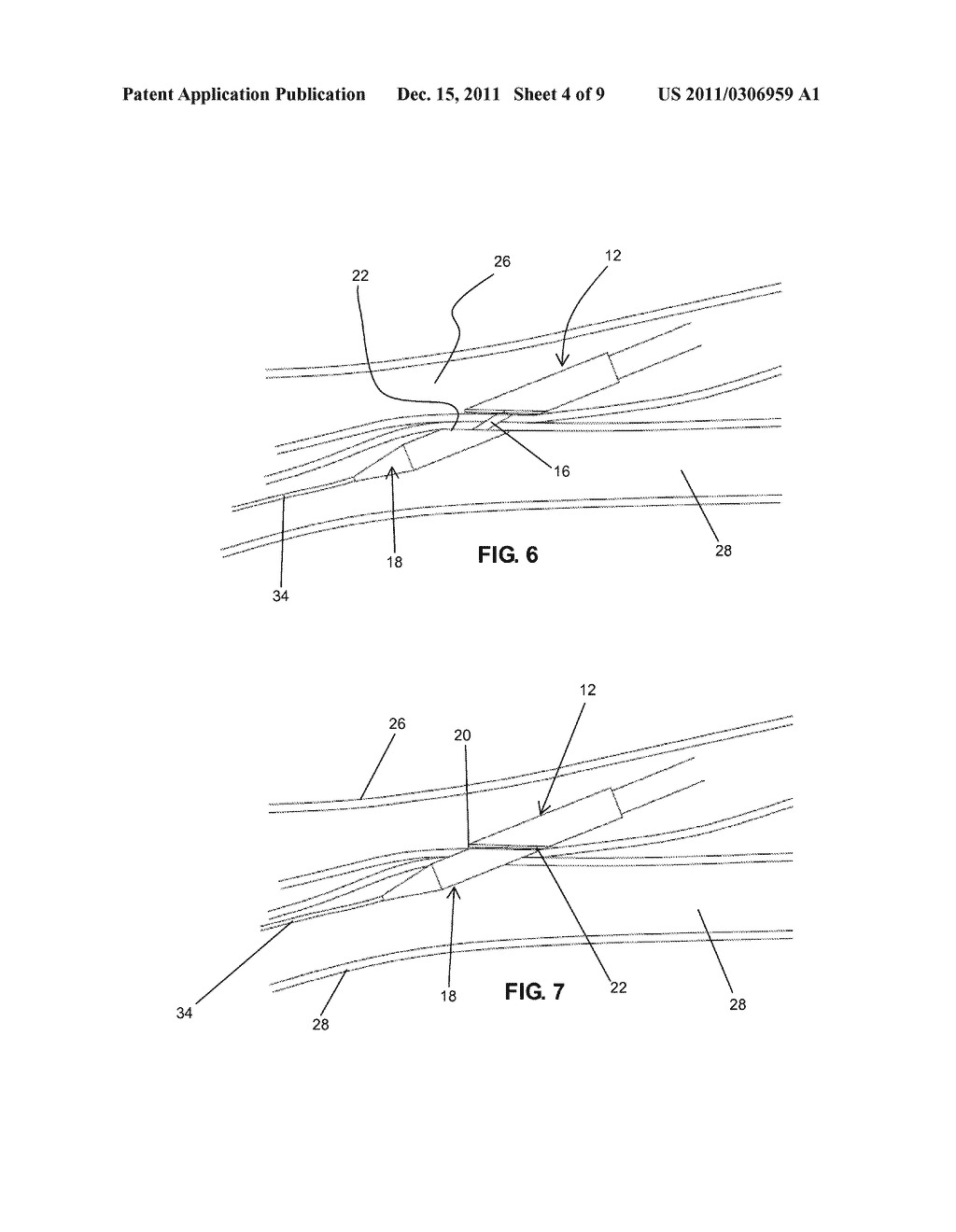 INTRAVASCULAR ARTERIAL TO VENOUS ANASTOMOSIS AND TISSUE WELDING CATHETER - diagram, schematic, and image 05