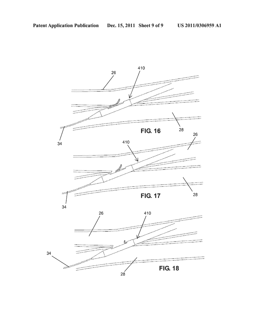 INTRAVASCULAR ARTERIAL TO VENOUS ANASTOMOSIS AND TISSUE WELDING CATHETER - diagram, schematic, and image 10