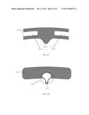 BONE PLATE AND KEEL SYSTEMS diagram and image