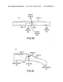 BONE PLATE AND KEEL SYSTEMS diagram and image