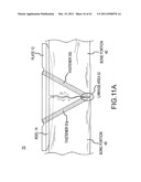 BONE PLATE AND KEEL SYSTEMS diagram and image