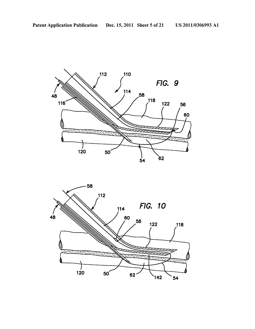 SYSTEMS AND METHODS FOR CREATING ARTERIOVENOUS (AV) FISTULAS - diagram, schematic, and image 06